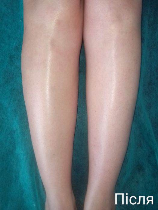 Депіляція видалення небажаного волосся