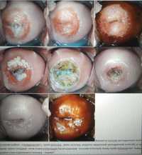 Папіломи, гострокінцеві кондиломи, невуси ,"ерозії", дисплазії