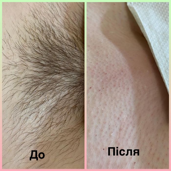 Шугаринг,воскова депіляція.