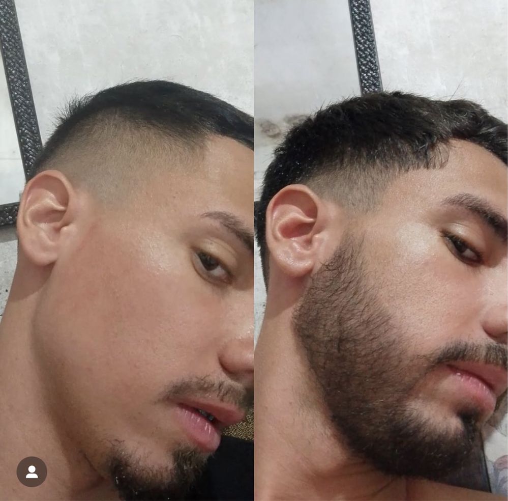 Minoxidi kirkland! Crescimento barba e cabelo