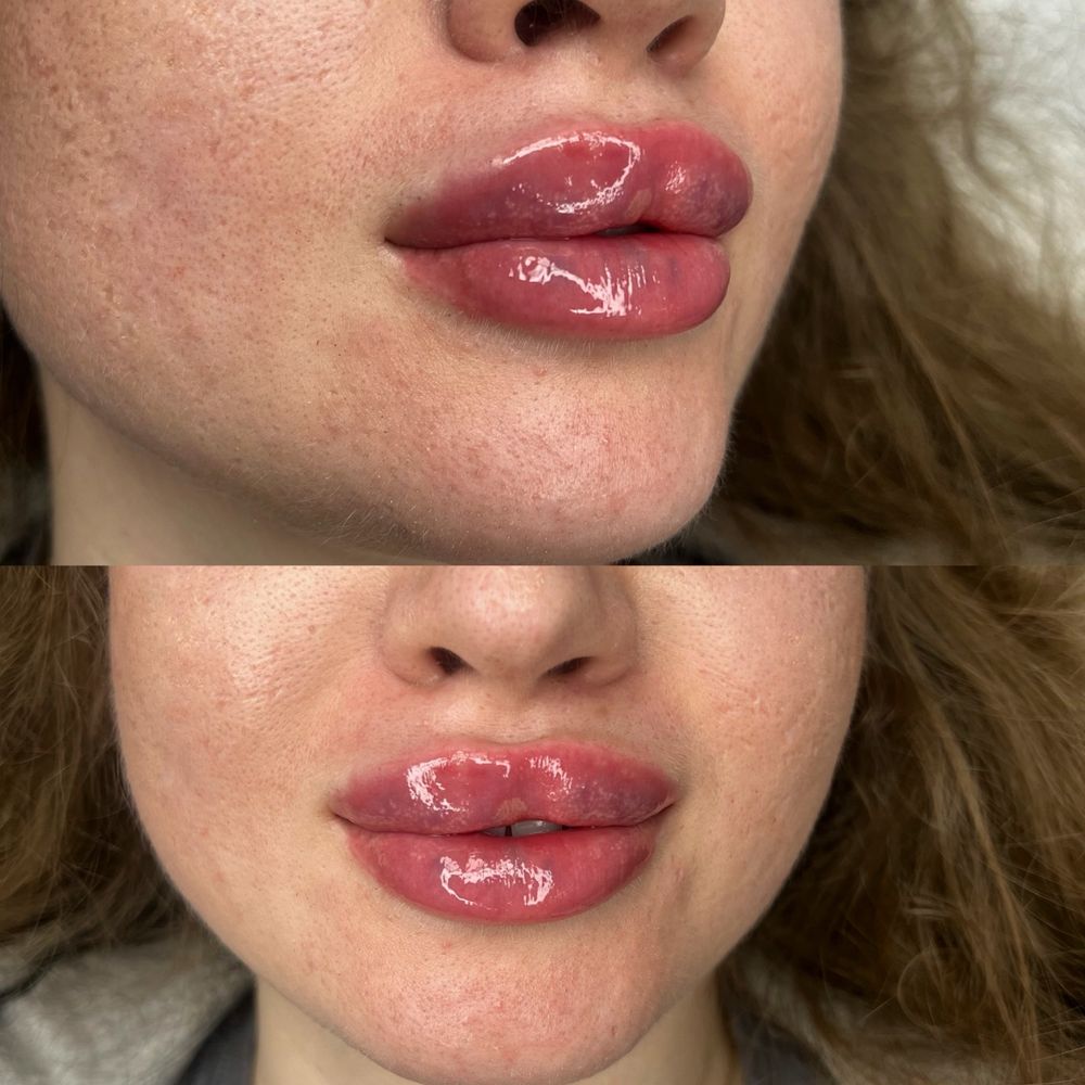 Powiększanie ust, botox , wolumetria, endermologia WARSZAWA 250 zł