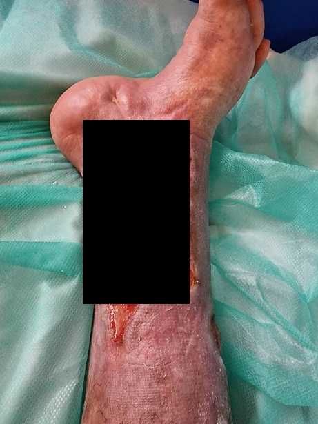 Pilna pomoc każda złotówka jest ważna. Udaje się uniknąć amputacji