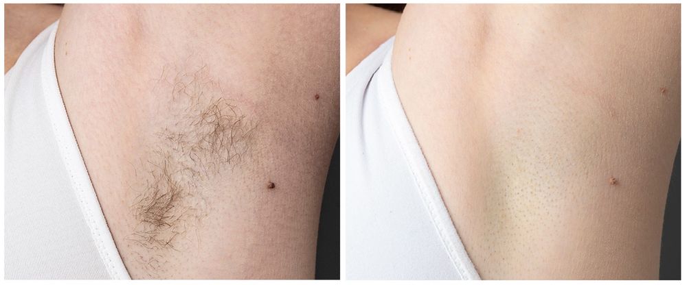 Zabieg Depilacji Laserowej / Endermologii -30% na wszystko