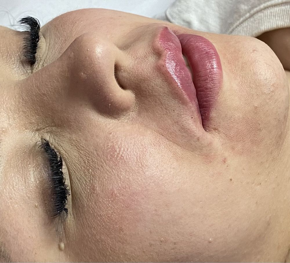 Powiększanie ust na płasko 1ml350zł,2ml450zł,botox,niciPDO4D,lipoliza,