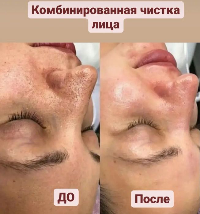 Косметолог- Дерматолог.Ботокс.Контурная пластика. Чистка лица. Массаж