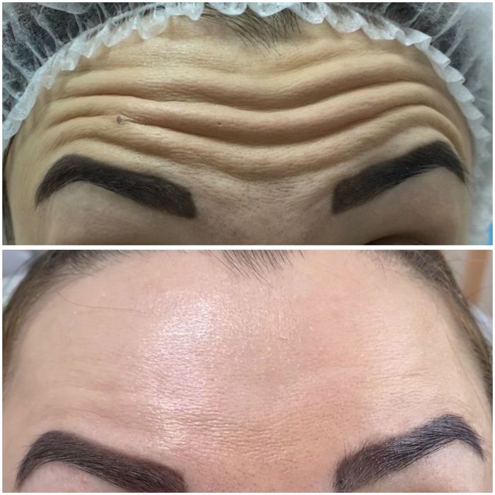 Безкоштовно збільшення губ / контурна пластика губ / ботокс