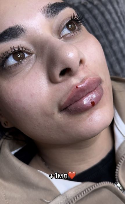 Ботокс.Увеличение губ.Гипергидроз