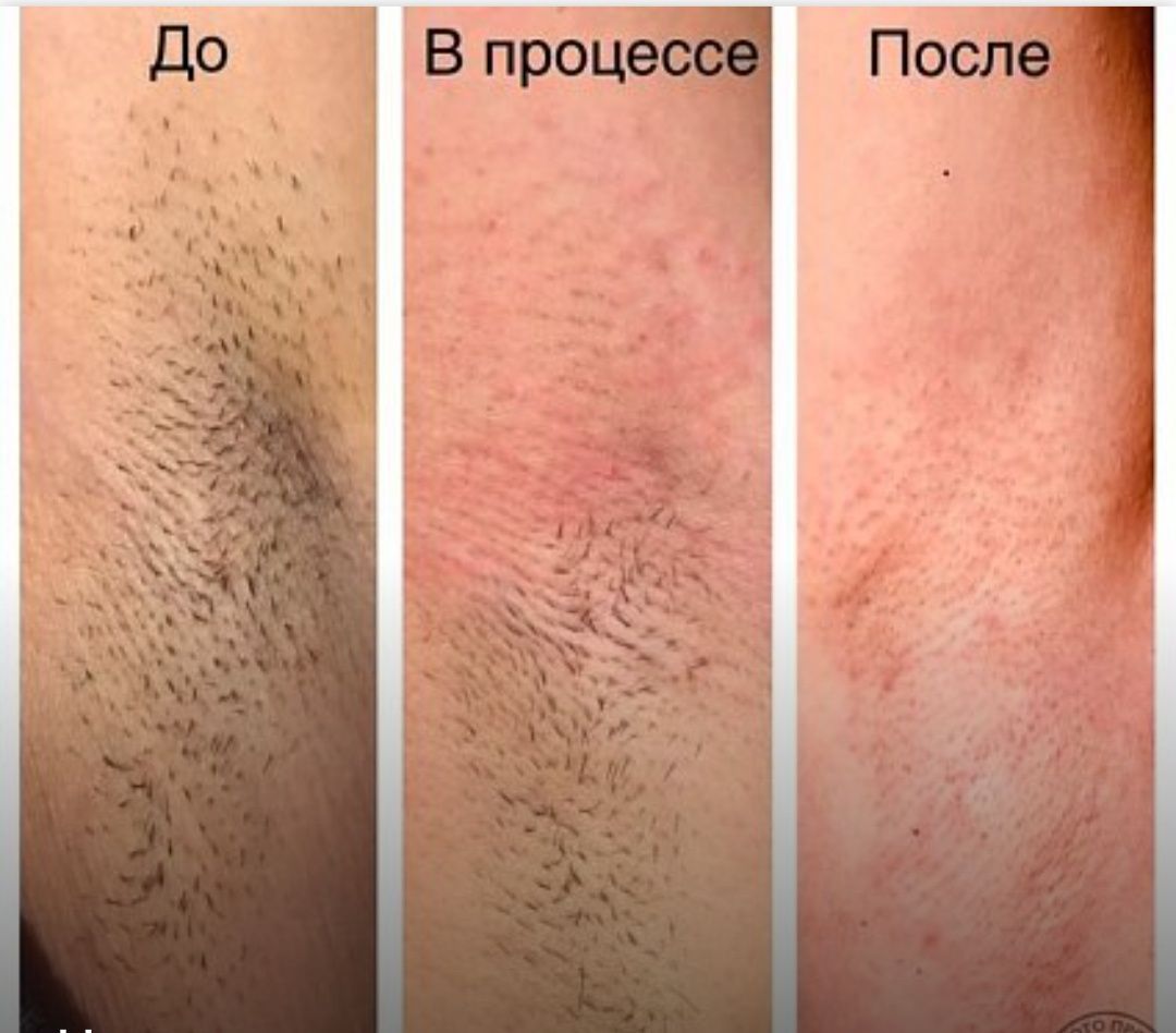Електроепіляція на Виноградарі
