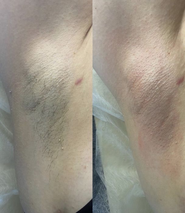 Шугаринг, сахарная депиляция 5 Заречный