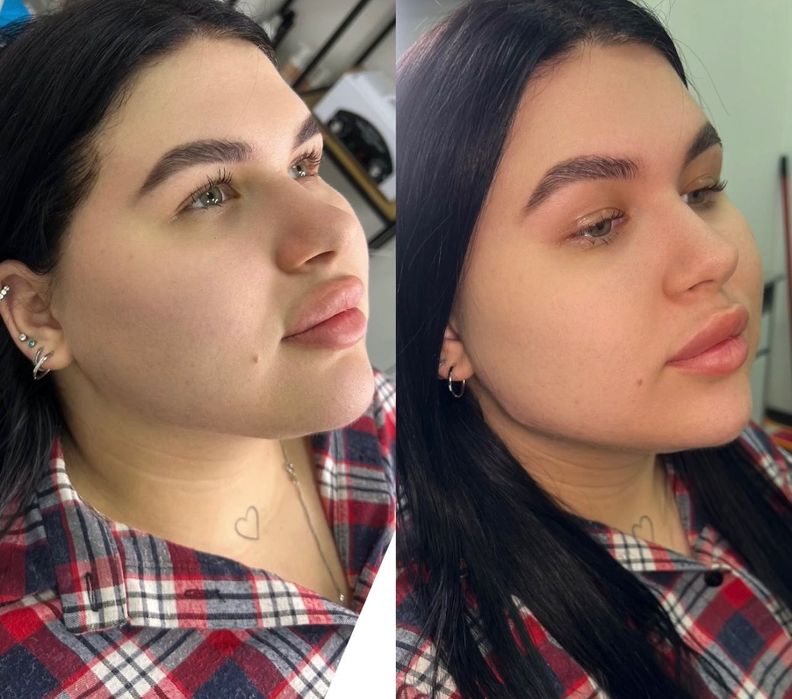 Модель на губы  ботокс Угли Джоли скули