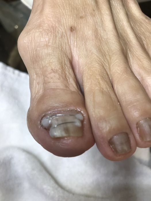Pedicure medical domiciliar