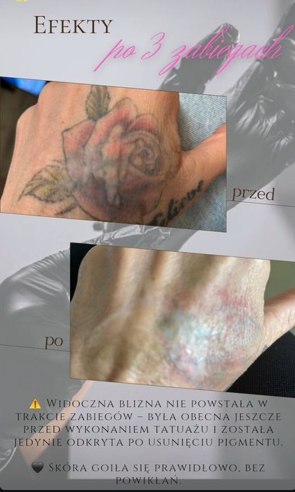 Laserowe Usuwanie Tatuażu i Makijażu Permanentnego - Studio Knurów