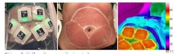 RF body thermage  D, modelowanie sylwetki , redukcja celulitu