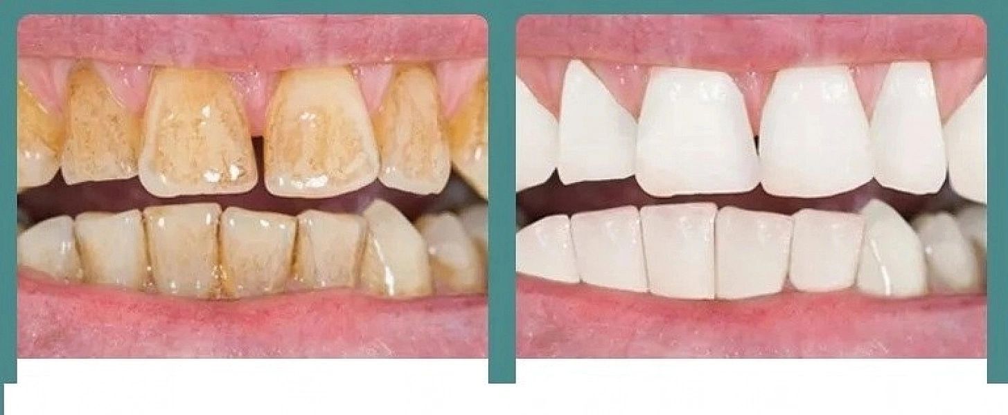 Ultradźwiękowy Skaler Dentystyczny - Precyzyjne Usuwanie Kamienia Nazę