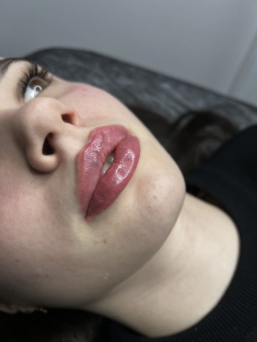 Губы от 2000грн, косметолог, ботокс,мезо-,био-, ТРК УКРАИНА