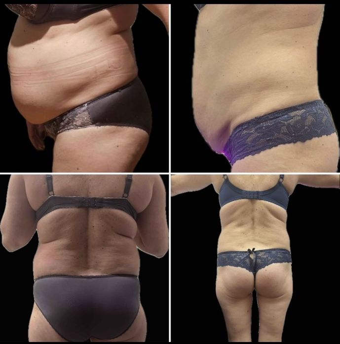 Modelowanie sylwetki i redukcja cellulitu – bez bólu i skalpela