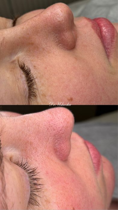 Модель на контурна пластика Губ/збільшення губ|Ботокс|Косметолог Одеса