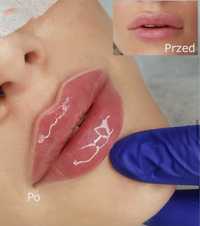 Powiększanie ust na płasko 1ml350zł,2ml450zł,botox,niciPDO4D,lipoliza,