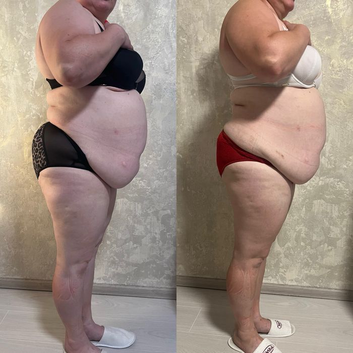 Пресотерапія, ліпопластика, лімфодренаж, кавітація  , масаж