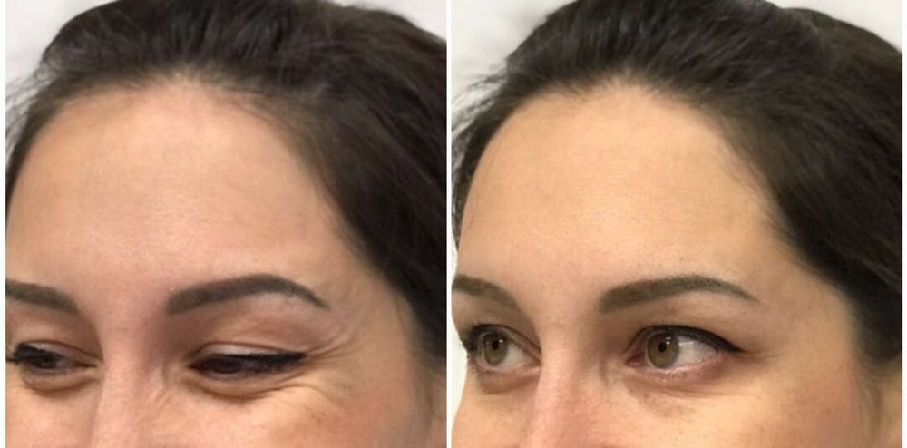 Ботулинотерапия! Гладкое личико! Ботокс!