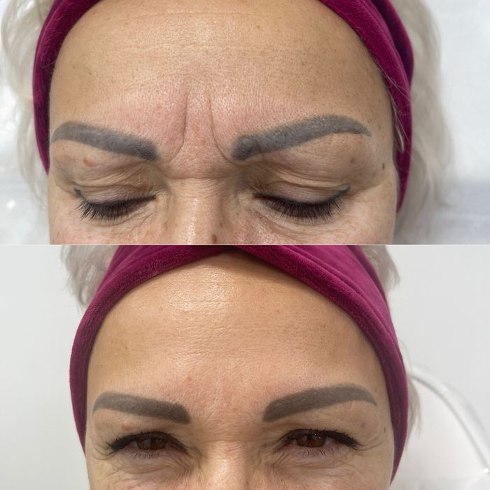 Ботулінотерапія, біоревіталізація, чистка обличчя