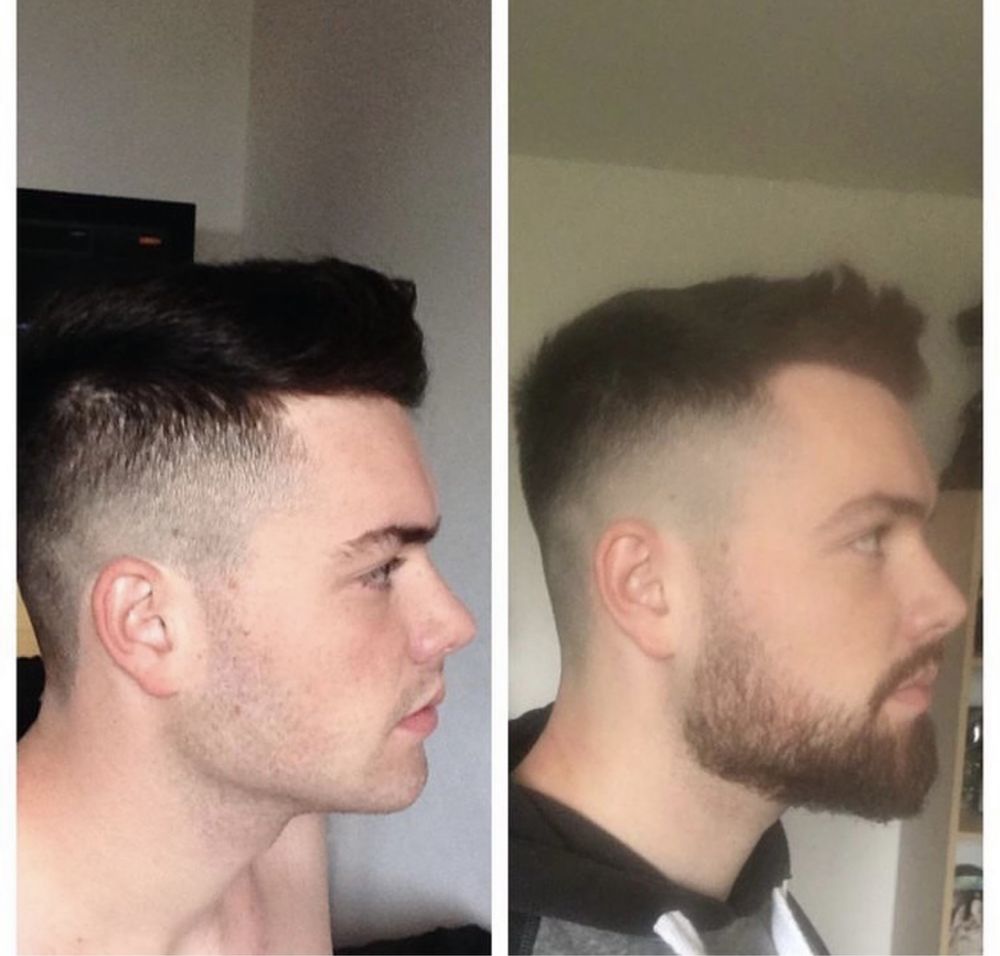 Minoxidil 3 frascos 60 ml + dermaroller