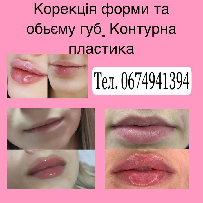 Послуги косметолога збільшення губ Ботокс Диспорт