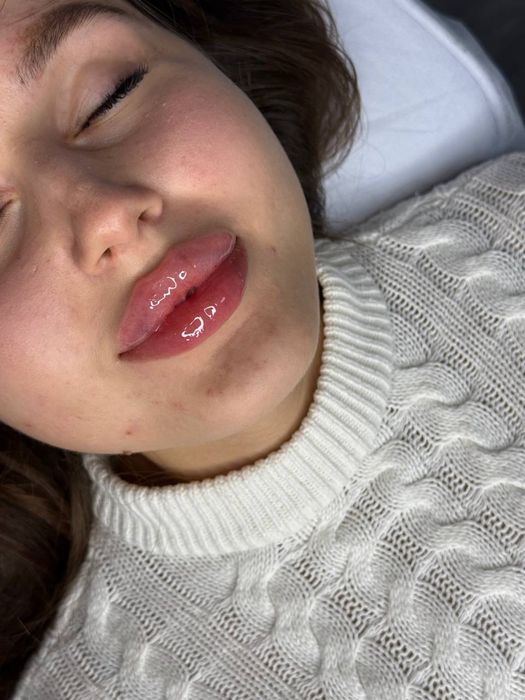 Збільшення губ,ботокс,мезотерапія,біоревіталізація,чистка обличчя