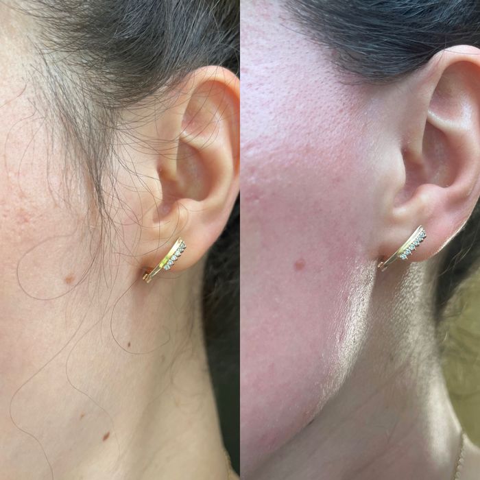 Депіляція Віск Шугарінг