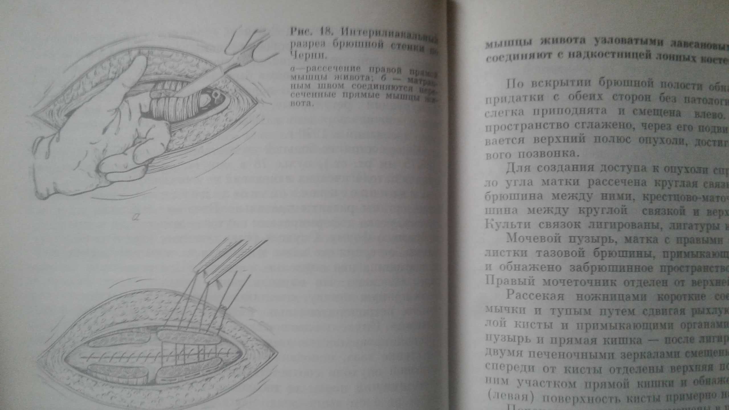 Атипичные гинекологические операции 1981 год