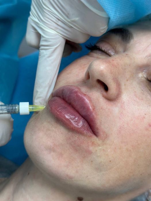 Увеличение губ , ботокс. Чистка лица