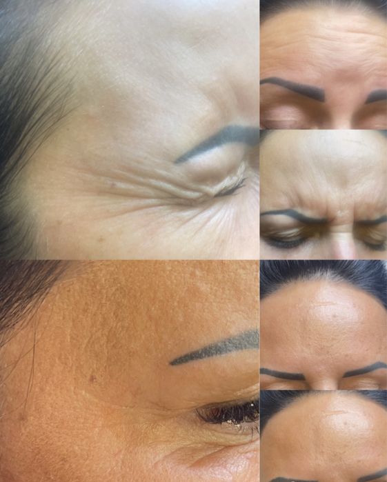 BTX , wygładzenie zmarszczek