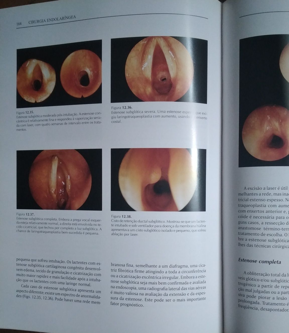 Cirurgia endolaríngea