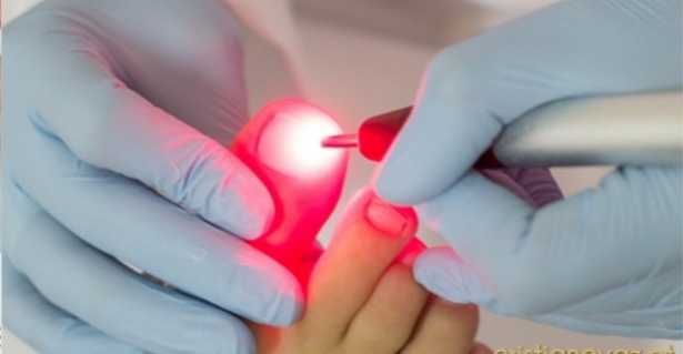 Laser podológico