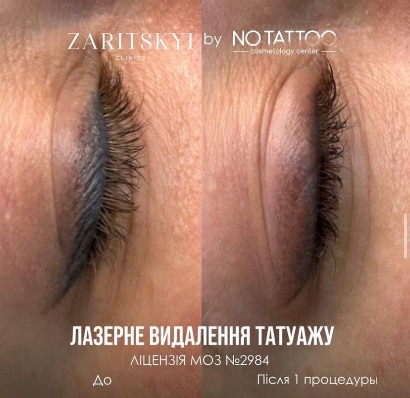 Лазерне видалення татуажу
