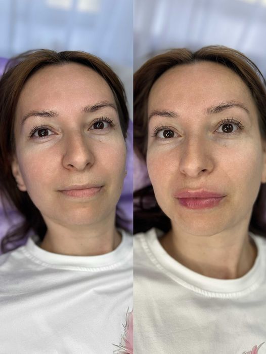 Акція. Контурна пластика губ. Запоріжжя