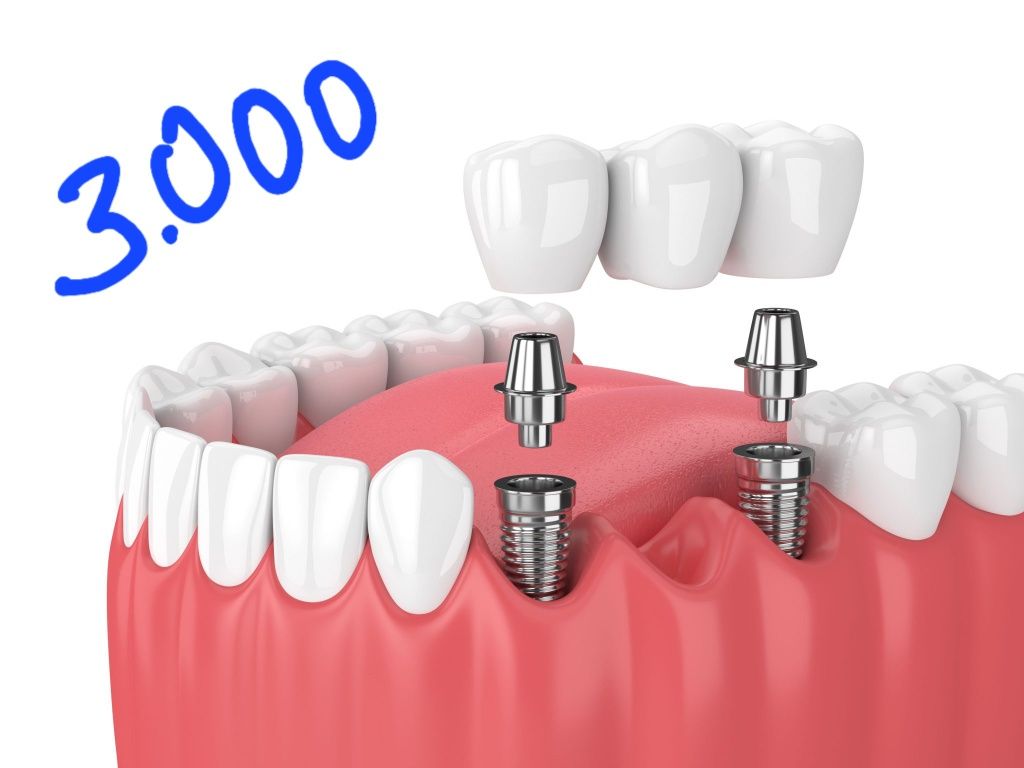 Зубна імплантація Київ недорого від 5000