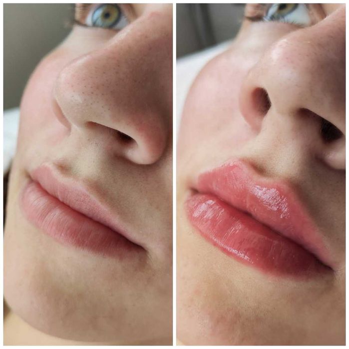 Увеличение губ, контурная коррекция