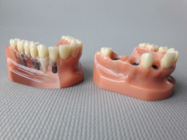 Демонстрационные модели челюсти - имплантация зубов