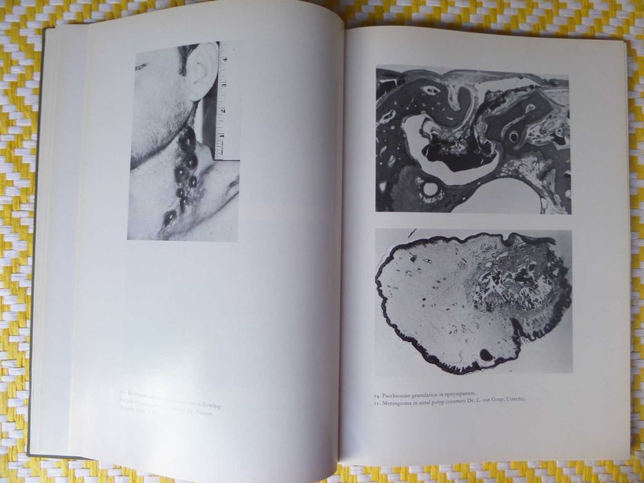 Atlas of the Histopathology of Ear Tumours
P.G. Gerlings