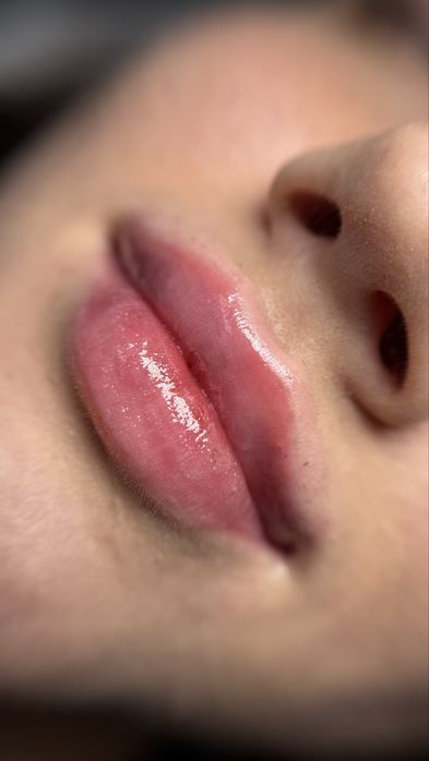 Powiększanie ust, stymulatory tkankowe