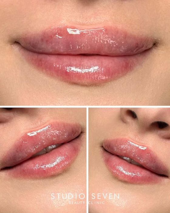 Powiekszanie ust, powiększanie, modelowanie ust