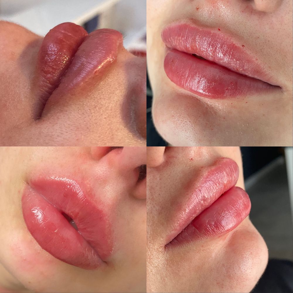 Powiększanie ust RUSSIAN LIPS 1ml 600zl, botox,dolina łez,volumetria