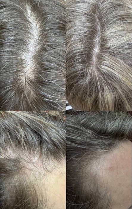 Трихолог, випадіння волосся, алопеція, пілінг шкіри голови, лупа