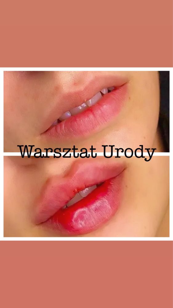 250zł= Botox - Botoks/ PLASMA IQ/ Wolumetria/ Powiększenie Ust -300zł