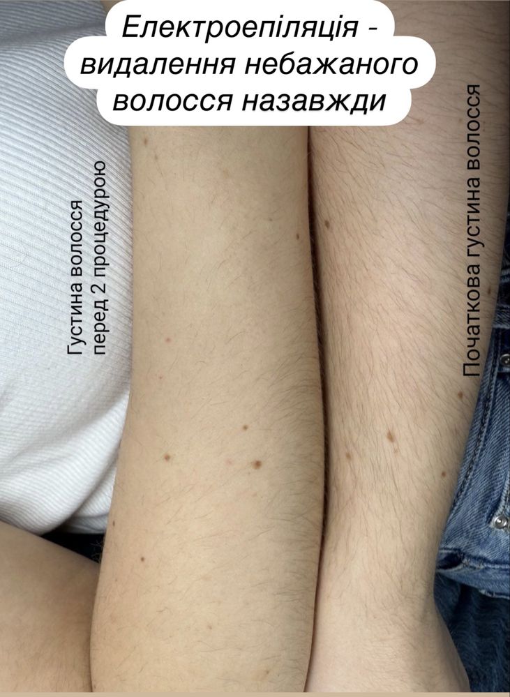 Електроепіляція-видалення небажаного волосся назавжди