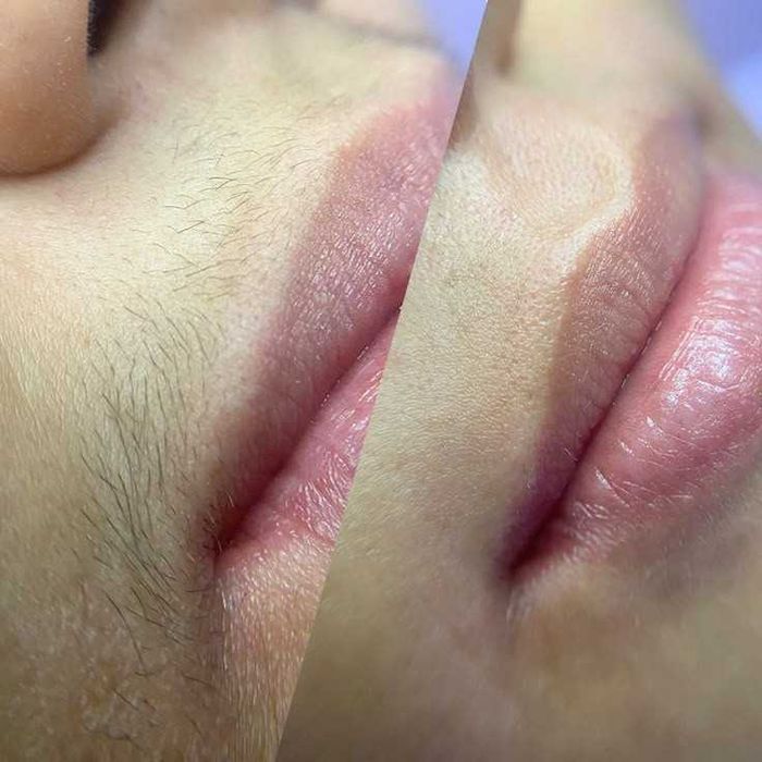 Депіляція, метро Дарниця,Воскресінка,Троєщина,Лівий берег