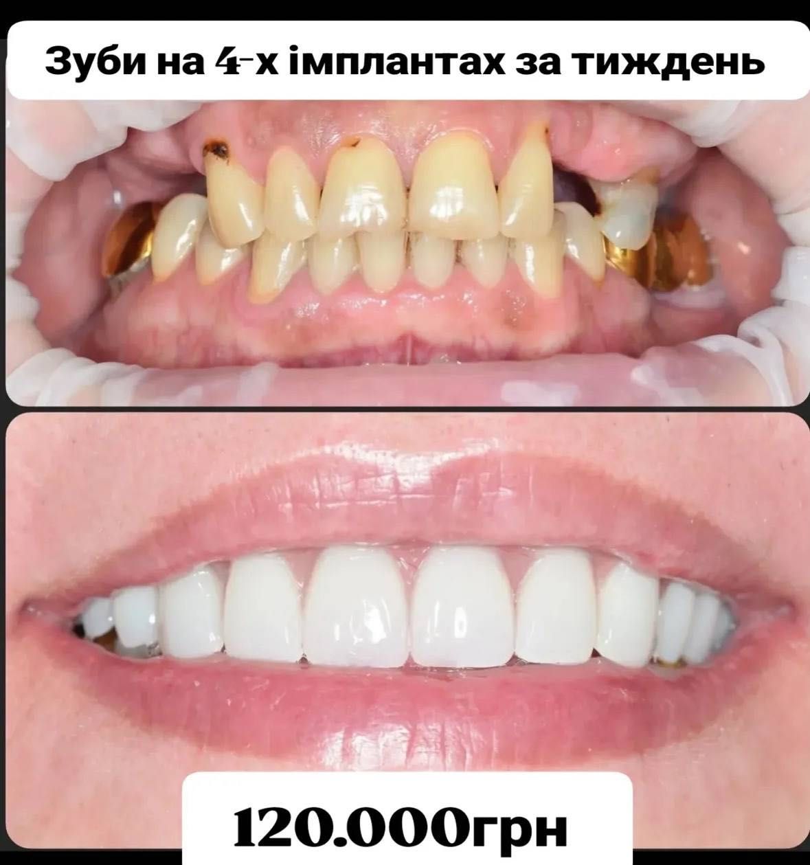 Імплантація зубів з гарантією — відновлення усмішки за 1 день