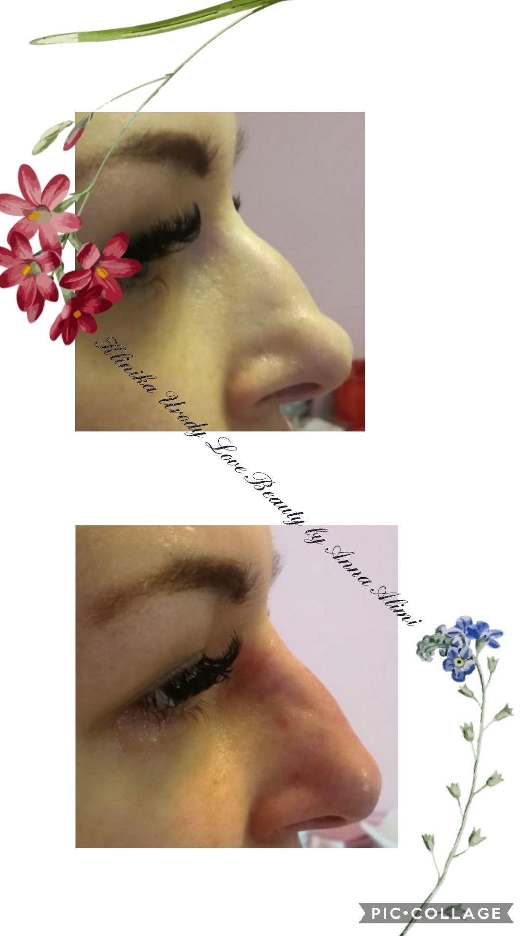 PROMOCJA botox powiększanie ust hialuronowy laser HIFU