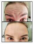 Promocja! Botox promocja 3 okolice 390zł do końca lipca!